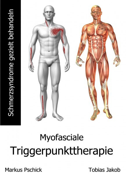Myofasciale Triggerpunkttherapie